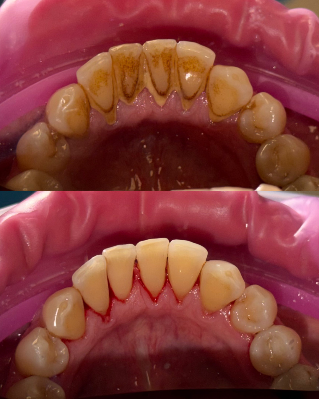 Before and after deep cleaning removing heavy tartar buildup from the lower teeth — Pro Dental Group, Levittown, PA
